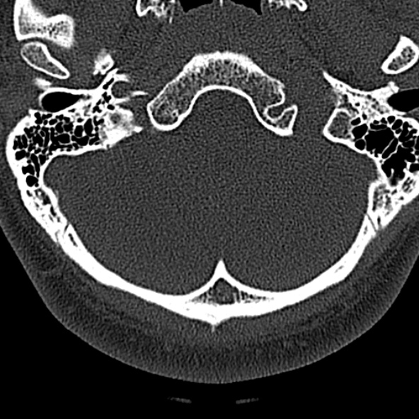 File:Normal CT of the cervical spine (Radiopaedia 53322-59305 Axial bone window 22).jpg