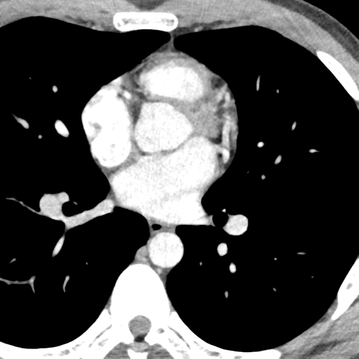 File:Normal CT pulmonary veins (pre RF ablation) (Radiopaedia 41748-44702 A 152).png