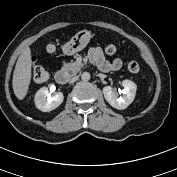 File:Normal CT split bolus study of the renal tract (Radiopaedia 48631-53634 Axial split bolus 71).jpg