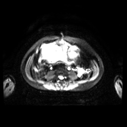 Normal MRI abdomen in pregnancy (Radiopaedia 88001-104541 Axial DWI 23).jpg