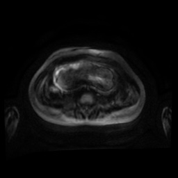 Normal MRI abdomen in pregnancy (Radiopaedia 88001-104541 Axial DWI 63).jpg