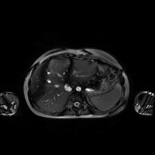 File:Normal MRI abdomen in pregnancy (Radiopaedia 88001-104541 Axial Gradient Echo 8).jpg