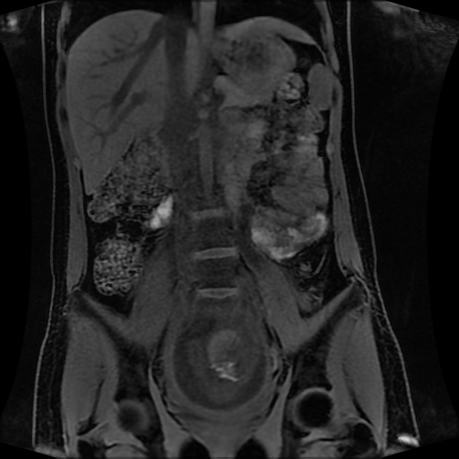 Normal MRI abdomen in pregnancy (Radiopaedia 88001-104541 M 76).jpg