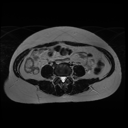 Normal MRI abdomen in pregnancy (Radiopaedia 88005-104548 Axial T2 7).jpg