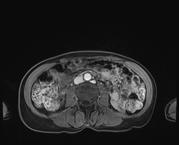 Normal adrenal glands MRI (Radiopaedia 82017-96004 K 57).jpg