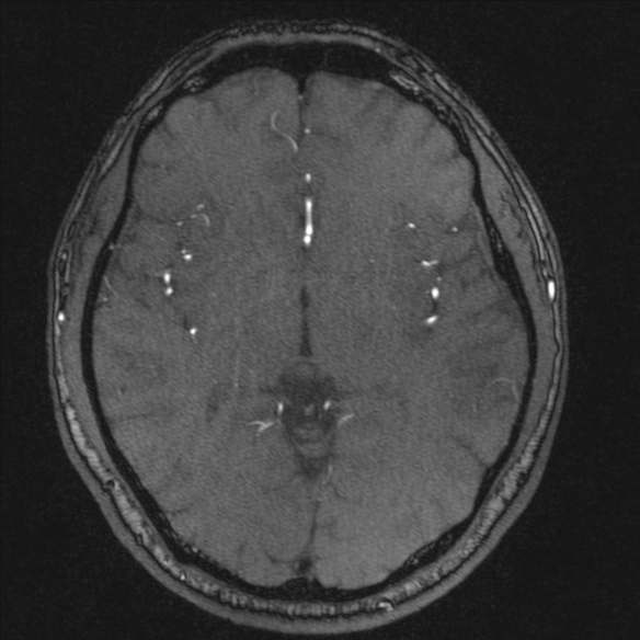 Normal brain MRI including MRA (Radiopaedia 48748-53763 Axial MRA 106).jpg