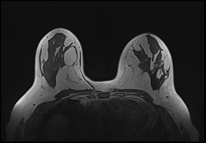 File:Normal breast MRI - dense breasts (Radiopaedia 80454-93850 Axial T1 109).jpg