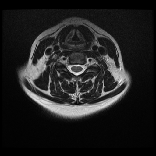 File:Normal cervical and thoracic spine MRI (Radiopaedia 35630-37156 Axial T2 17).png