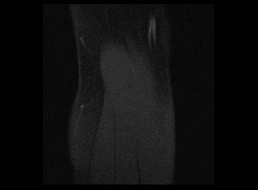 File:Normal elbow arthrograms (Radiopaedia 75550-86805 Sagittal T1 fat sat 1).jpg