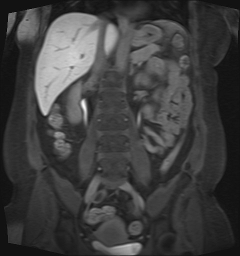 File:Normal hepatobiliary phase liver MRI (Radiopaedia 58968-66230 B 22).jpg