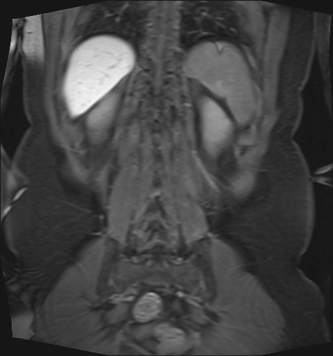File:Normal hepatobiliary phase liver MRI (Radiopaedia 58968-66230 B 8).jpg