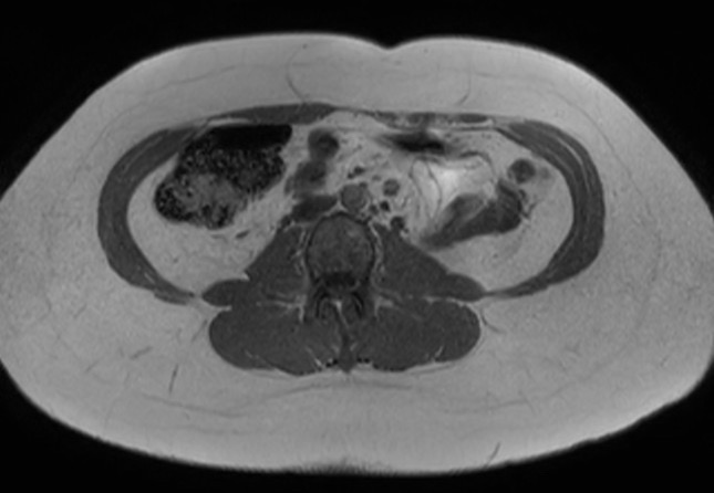 File:Normal liver MRI with Gadolinium (Radiopaedia 58913-66163 Axial T1 in-phase 3).jpg