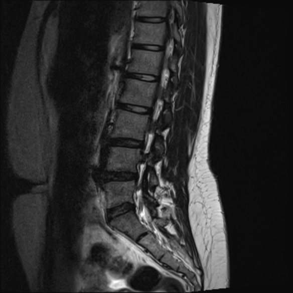 File:Normal lumbar spine MRI- 3 T (Radiopaedia 53280-59250 Sagittal T2 10).jpg