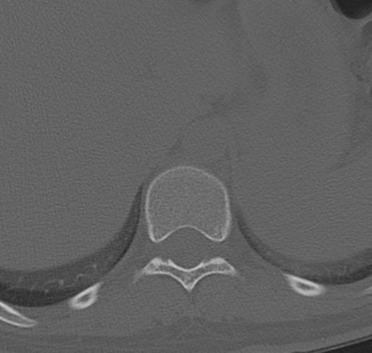 File:Normal lumbosacral CT (Radiopaedia 37923-39867 Axial bone window 4).png