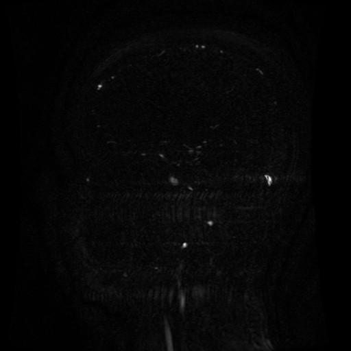 Normal noncontrast MR venography (Radiopaedia 87578-103957 A 107).jpg