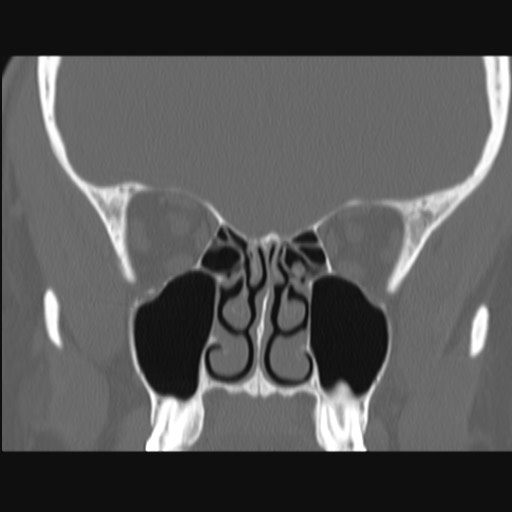 Normal sinus CT (annotated) (Radiopaedia 78917-91810 Coronal bone window 32).jpg