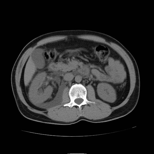 File:Obstructed kidney with perinephric urinoma (Radiopaedia 26889-27066 Axial non-contrast 21).jpg