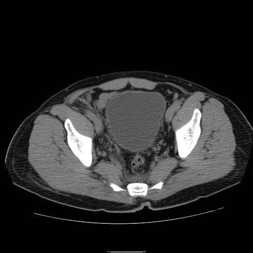 File:Obstructed kidney with perinephric urinoma (Radiopaedia 26889-27066 Axial non-contrast 58).jpg