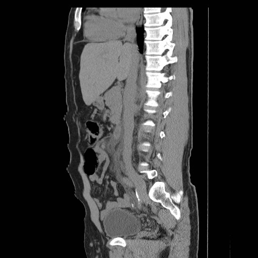 File:Obstructed kidney with perinephric urinoma (Radiopaedia 26889-27066 B 26).jpg