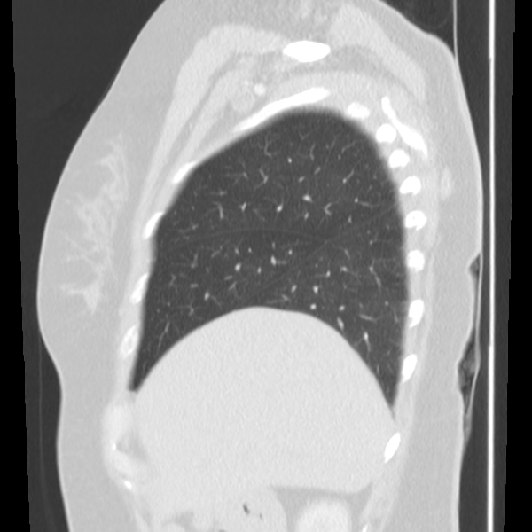 Obstructing typical carcinoid causing bronchoceles (Radiopaedia 50149-55476 Sagittal lung window 12).png