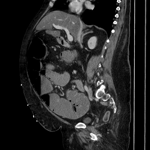 Obstructive colonic diverticular stricture (Radiopaedia 81085-94675 C 107).jpg