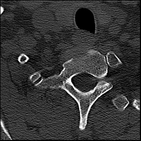 Occipital condyle fracture (type 1) (Radiopaedia 87670-104084 Axial bone window 85).jpg