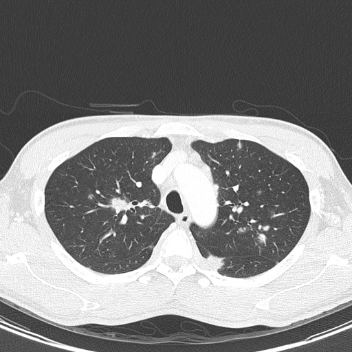 AIDS-related Kaposi sarcoma (Radiopaedia 85247-100811 Axial lung window 44).jpg