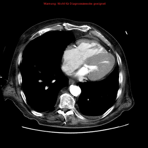 Abdominal aortic aneurysm- extremely large, ruptured (Radiopaedia 19882-19921 Axial C+ arterial phase 2).jpg