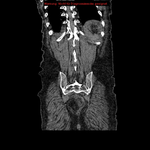 File:Abdominal aortic aneurysm- extremely large, ruptured (Radiopaedia 19882-19921 Coronal C+ arterial phase 91).jpg