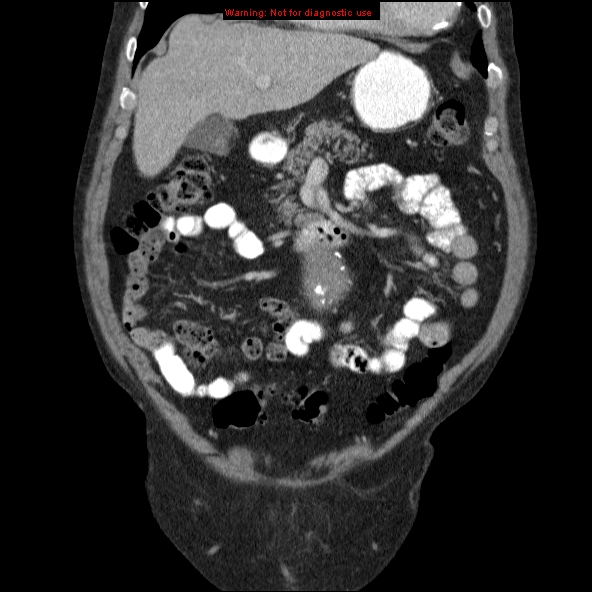 File:Abdominal aortic aneurysm (Radiopaedia 10122-10660 Coronal C+ portal venous phase 4).jpg