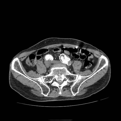 Abdominal aortic aneurysm (Radiopaedia 13341-13340 Axial C+ arterial phase 171).jpg