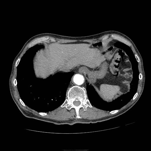 Abdominal aortic aneurysm (Radiopaedia 13341-13340 Axial C+ arterial phase 19).jpg