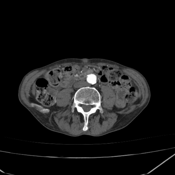 Abdominal aortic aneurysm (Radiopaedia 23703-23856 Axial C+ arterial phase 54).jpg