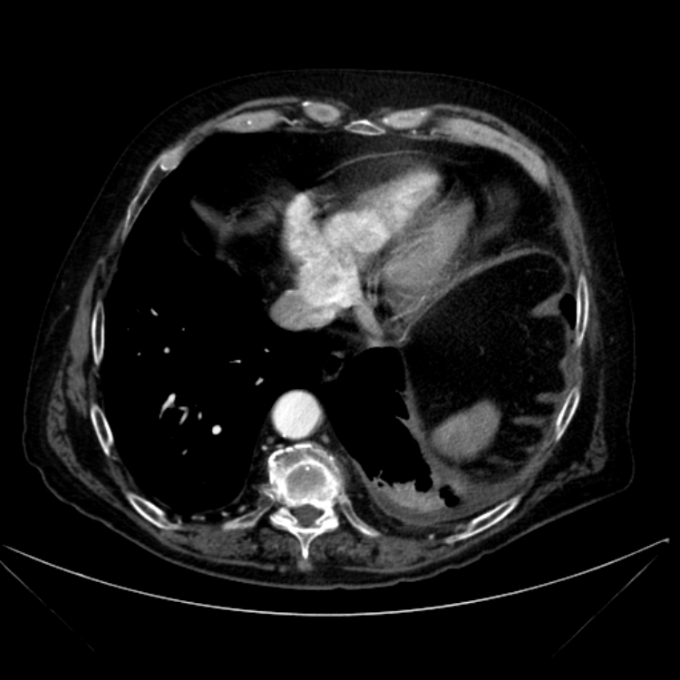 Abdominal aortic aneurysm (Radiopaedia 25855-26001 Axial C+ arterial phase 16).jpg
