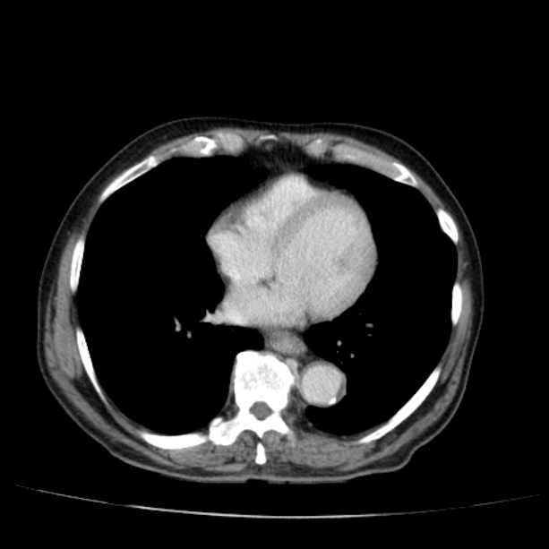 Abdominal aortic aneurysm (Radiopaedia 29248-29660 Axial C+ portal venous phase 1).jpg