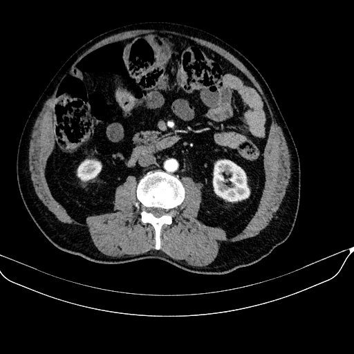 Abdominal aortic aneurysm (Radiopaedia 67117-76452 Axial C+ arterial phase 68).jpg