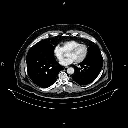 Abdominal aortic aneurysm (Radiopaedia 83094-97462 Axial renal cortical phase 49).jpg