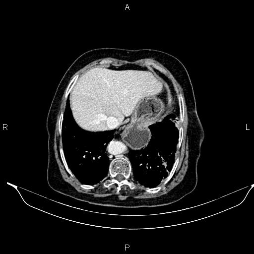 File:Abdominal aortic aneurysm (Radiopaedia 85063-100606 Axial C+ portal venous phase 27).jpg
