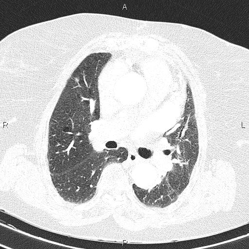 File:Abdominal aortic aneurysm (Radiopaedia 85063-100606 Axial lung window 32).jpg