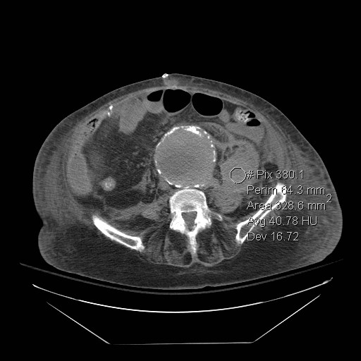 Abdominal aortic aneurysm - impending rupture (Radiopaedia 19233-19247 Axial non-contrast 107).jpg