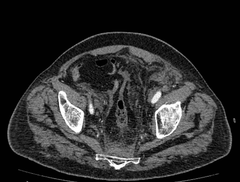 Abdominal aortic aneurysm rupture (Radiopaedia 54179-60362 Axial C+ portal venous phase 4).jpg