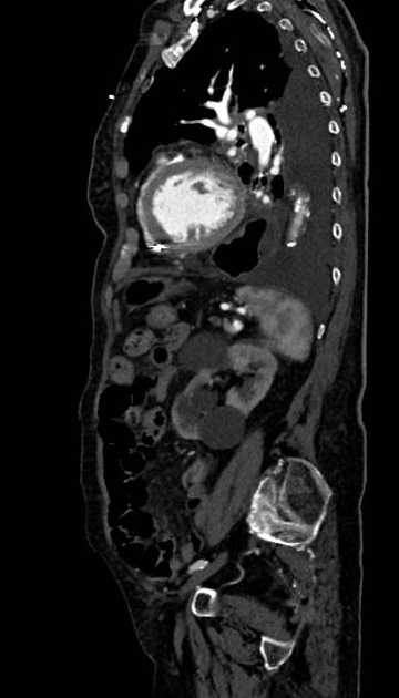 Abdominal aortic aneurysm with thrombus fissuration (Radiopaedia 73192-83919 Sagittal C+ arterial phase 39).jpg