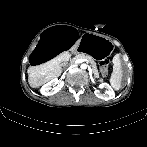 File:Abdominal collection due to previous cecal perforation (Radiopaedia 80831-94320 Axial C+ portal venous phase 71).jpg
