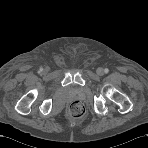 Abdominal hematoma (Radiopaedia 33614-34715 Axial C+ portal venous phase 134).png