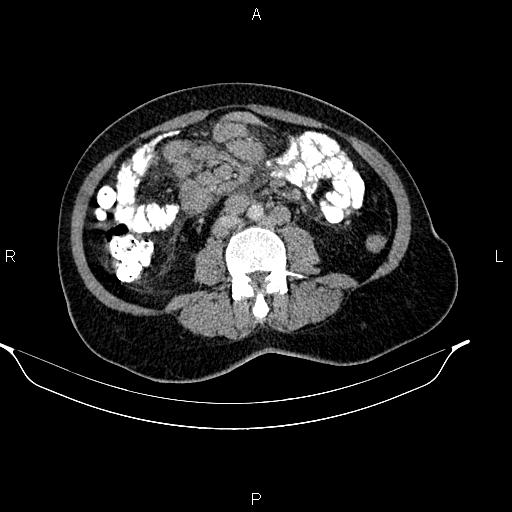 Abdominal lymphoma with sandwich sign (Radiopaedia 84378-99704 Axial C+ portal venous phase 33).jpg