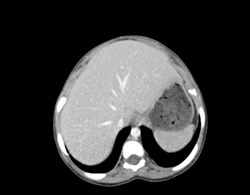 Abdominal premesenteric cystic lymphangioma (Radiopaedia 82995-97350 Axial C+ portal venous phase 5).jpg