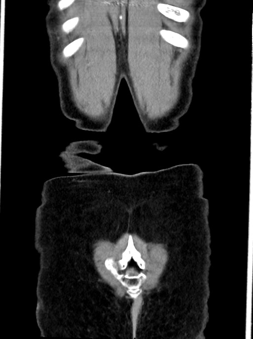 Abdominal wall and retroperitoneal tuberculosis (Radiopaedia 88137-104729 Coronal C+ portal venous phase 99).jpg