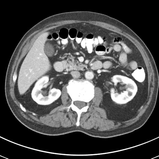 File:Abdominal wall metastasis from colorectal carcinoma (Radiopaedia 31016-31717 Axial C+ portal venous phase 31).jpg
