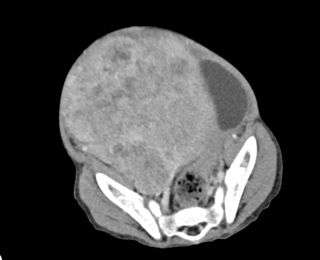 File:Abdominopelvic rhabdomyosarcoma (Radiopaedia 78356-90984 Axial C+ portal venous phase 131).jpg