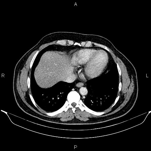 File:Aberrant right subclavian artery (Radiopaedia 87093-103354 Axial With contrast 84).jpg